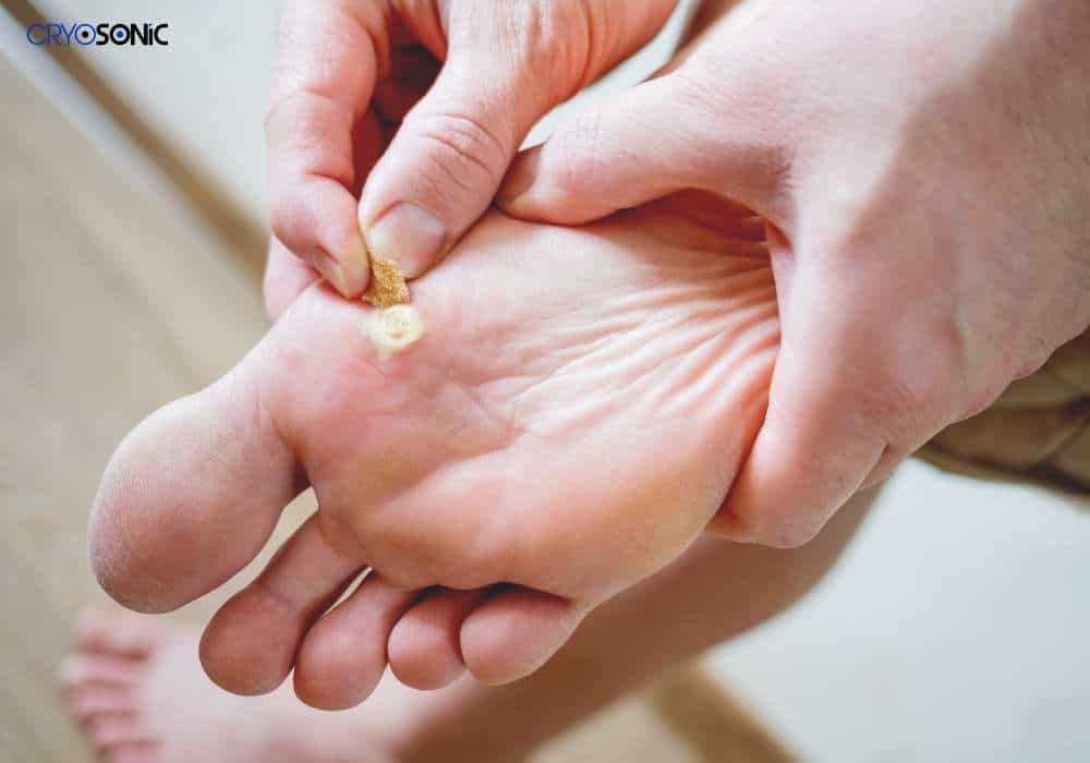 Common plantar warts on the ball of the foot Cardiff