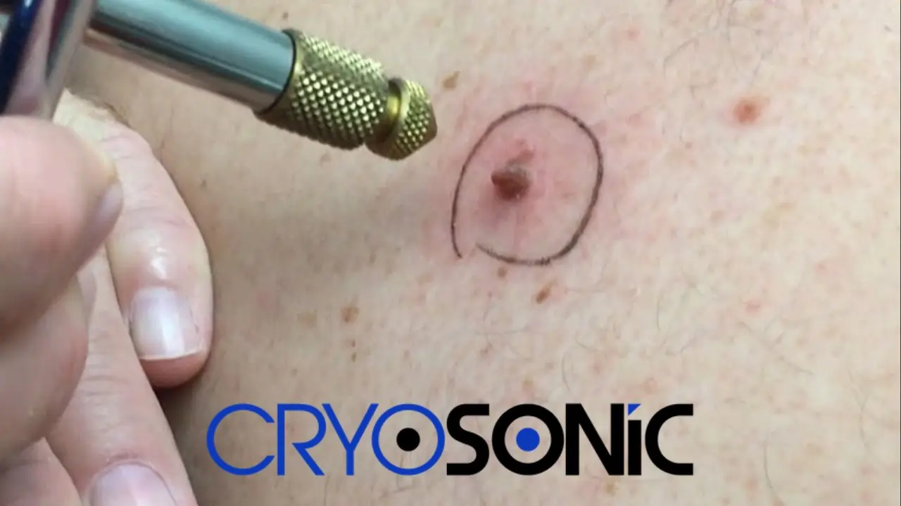 What Happens When A Mole Or Skin Tag Gets Frozen Off With Liquid Nitrogen Cardiff