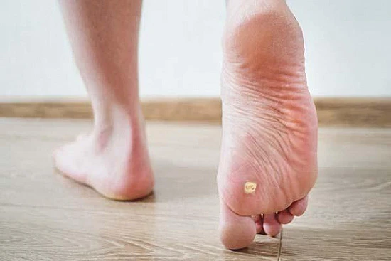 CryoPen treatment removing stubborn Plantar Warts (Verrucae) for precise, safe, and effective relief from resistant lesions Cardiff